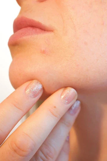 Best Skincare Products for Acne: Simple, Safe Picks