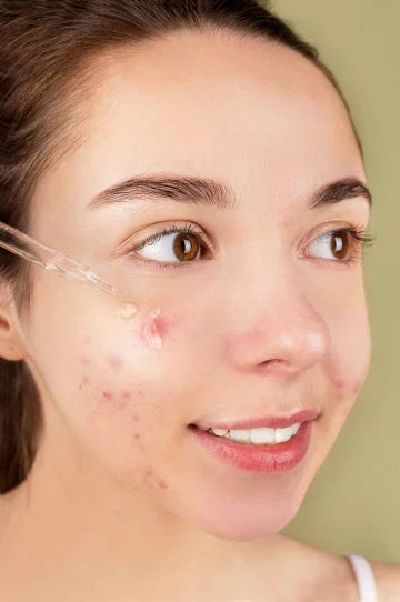 Acne Scars: Causes and How to Get Rid of It?