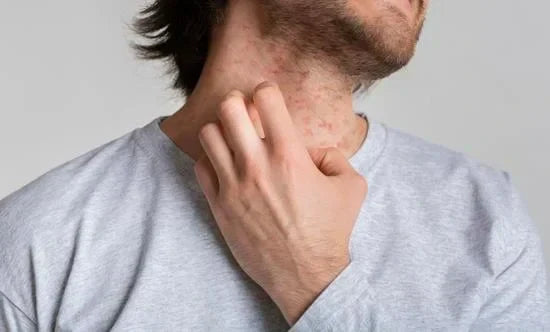 Best-Medicine-for-Itching-Rashes