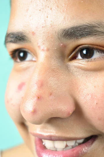 Effective-Natural-Ways-to-Remove-Pimple-Scars
