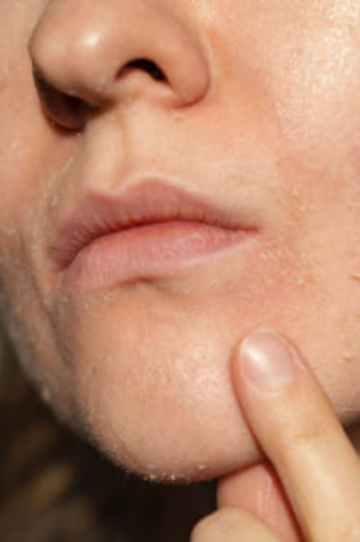 Hyperpigmentation Around Lips and Gentle Care Tips