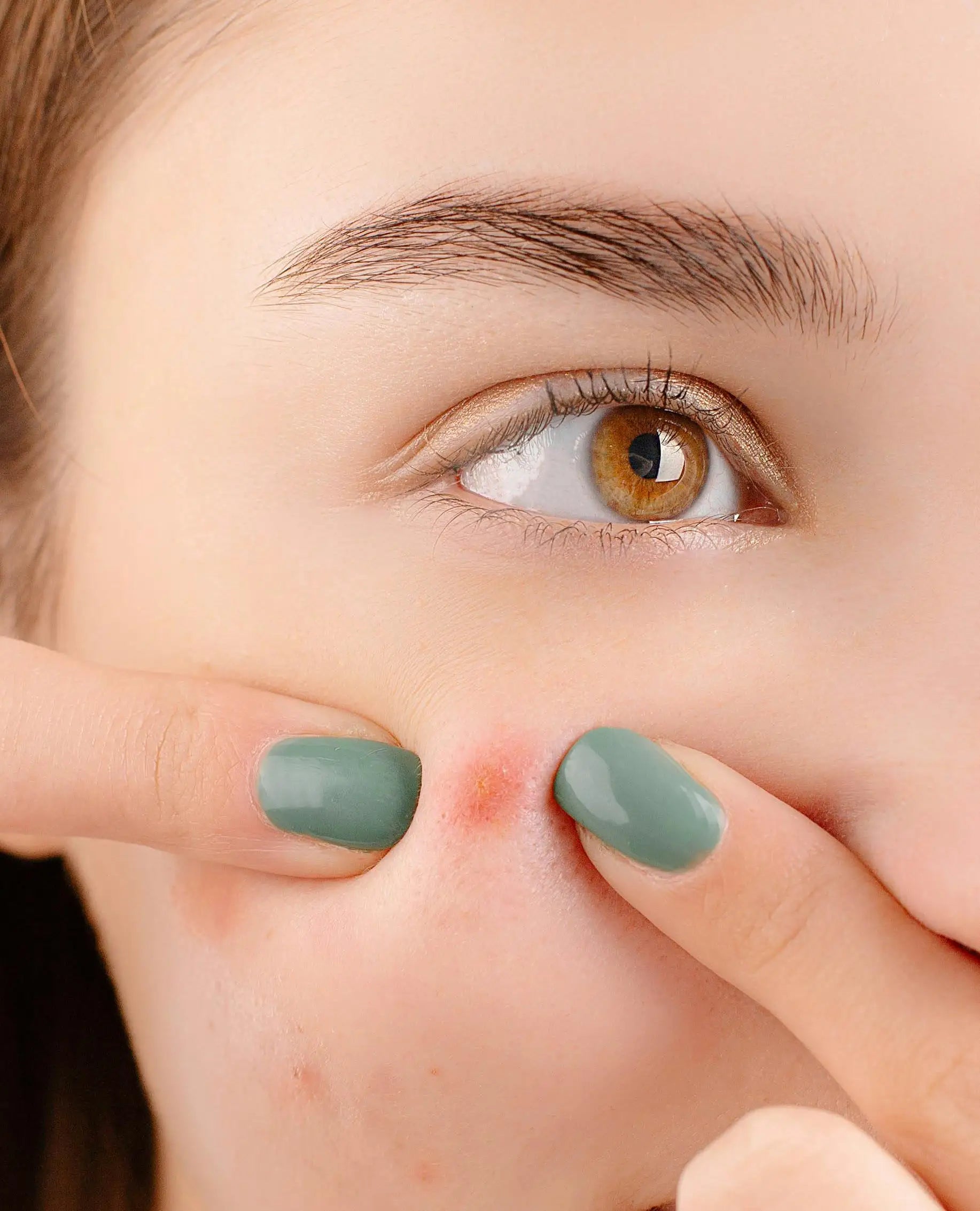 Ayurvedic-Cure-Solution-for-Pimples