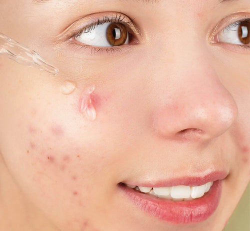 amiy-naturals-acne-care-skin-health