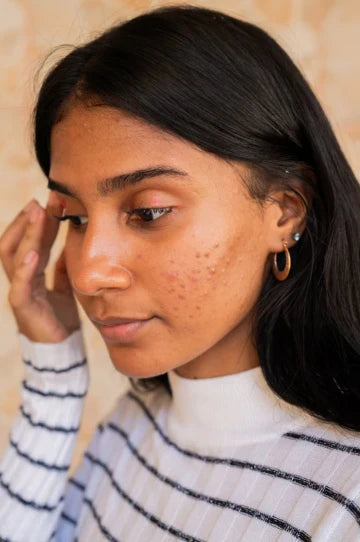 AcneFluence! Some of the Best Trending Skinfluencers Tackling Acne the Positive Way