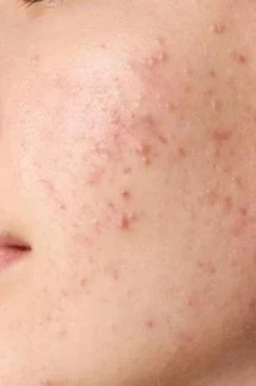 Ayurvedic Treatment for Acne & Pimples | Amiy Naturals