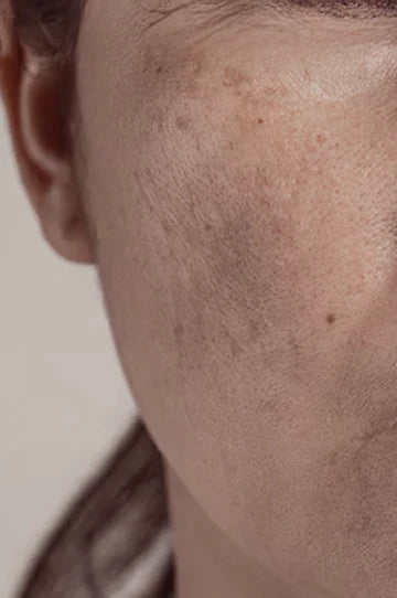 Pigmentation Before Wedding: Clear, Even Glow Plan