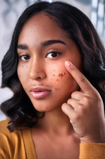 Dating the Dots: How to Navigate through the 21st-century Dating Scene with Acne?