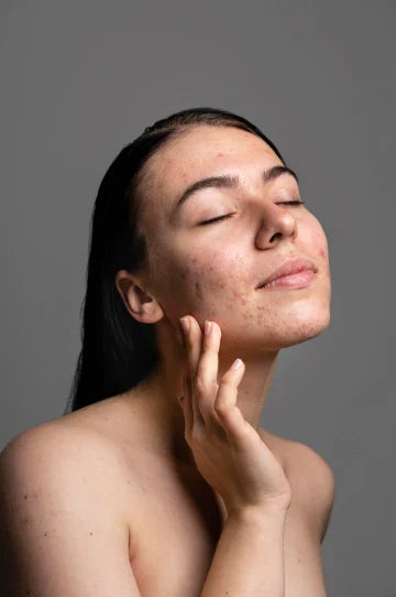 Dry Skin Acne: What is It and How to Treat it with Everyday Habits
