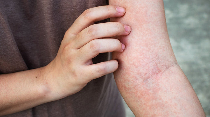 Natural remedies for inflammation: easy, safe ways to feel better