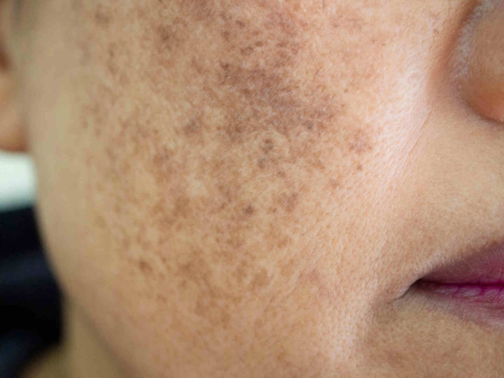 Dry skin remedies: simple, natural fixes that work