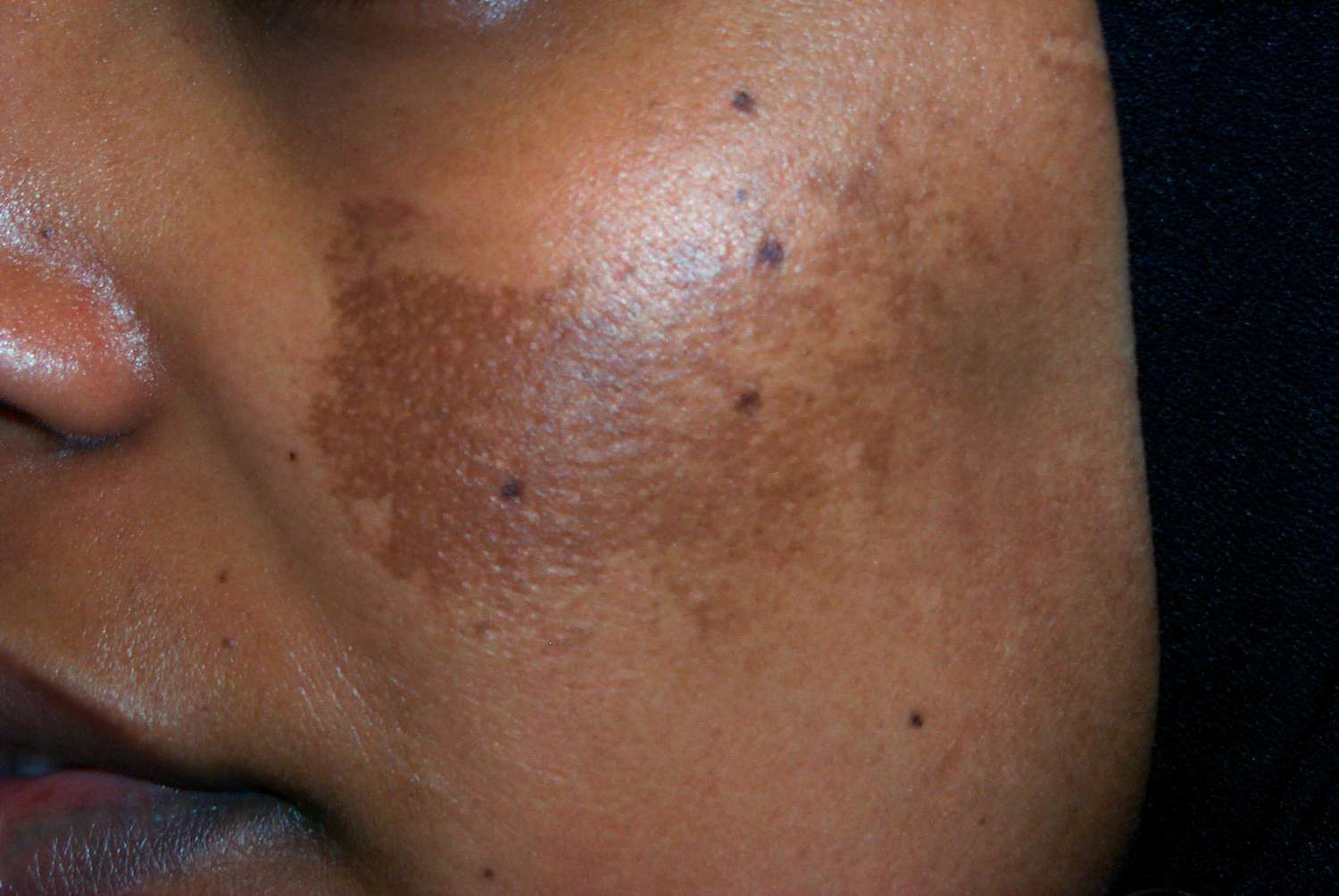 Acne remedies: simple, safe home solutions