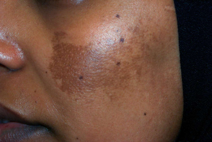 Acne remedies: simple, safe home solutions