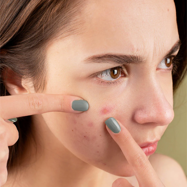 Teen acne: How to minimize the problem-year acne on the skin