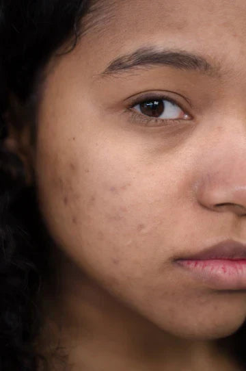 Best Treatment for Hyperpigmentation on Face | Amiy Natural
