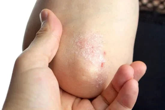 Ayurvedic Medicine for Psoriasis: Treatment Guide