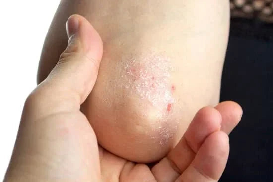 Best Natural Remedies for Psoriasis | Amiy Naturals