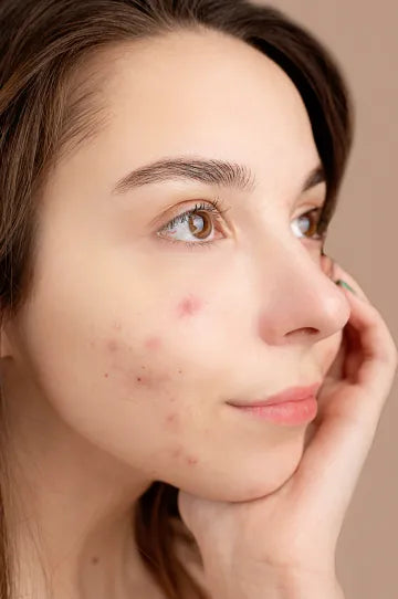 Buy Ayurvedic Alternative to Pimples & Pigmentation Creams