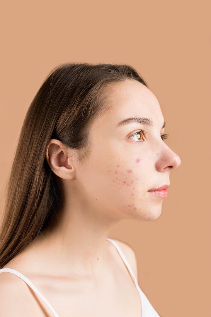 get rid of acne scars naturally: simple steps for clear, even skin