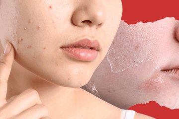 Ayurvedic Solutions For Acne That Works Naturally