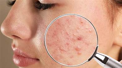 Natural Remedies for Dark Spots After Acne | Fade PIH