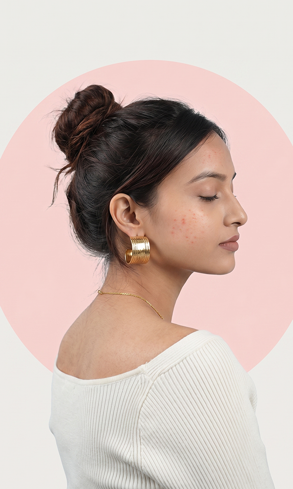 Acne SOS: Why Breakouts Keep Coming Back Even After Skincare Changes