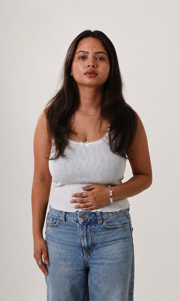 Hormonal Acne Causes: Why It Keeps Coming Back (And It's Not Just Your Skin)