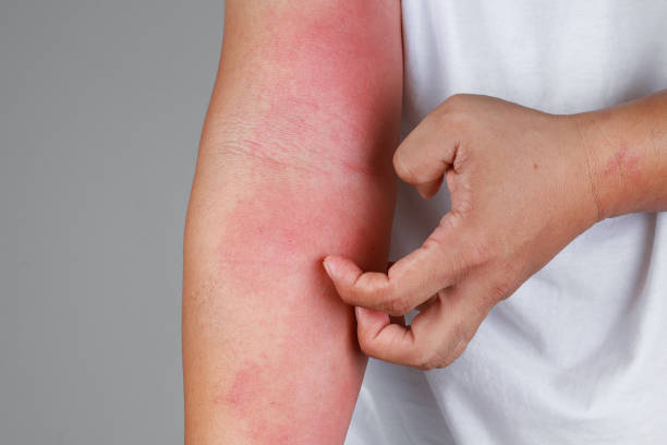 Natural remedies for inflammation: easy, safe ways to feel better